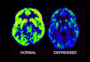 Cerveau dépressif et cerveau sain